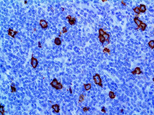 IHC of CD15 Rmab on an FFPE Hodgkin’s Lymphoma Tissue
